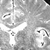T2 brain image